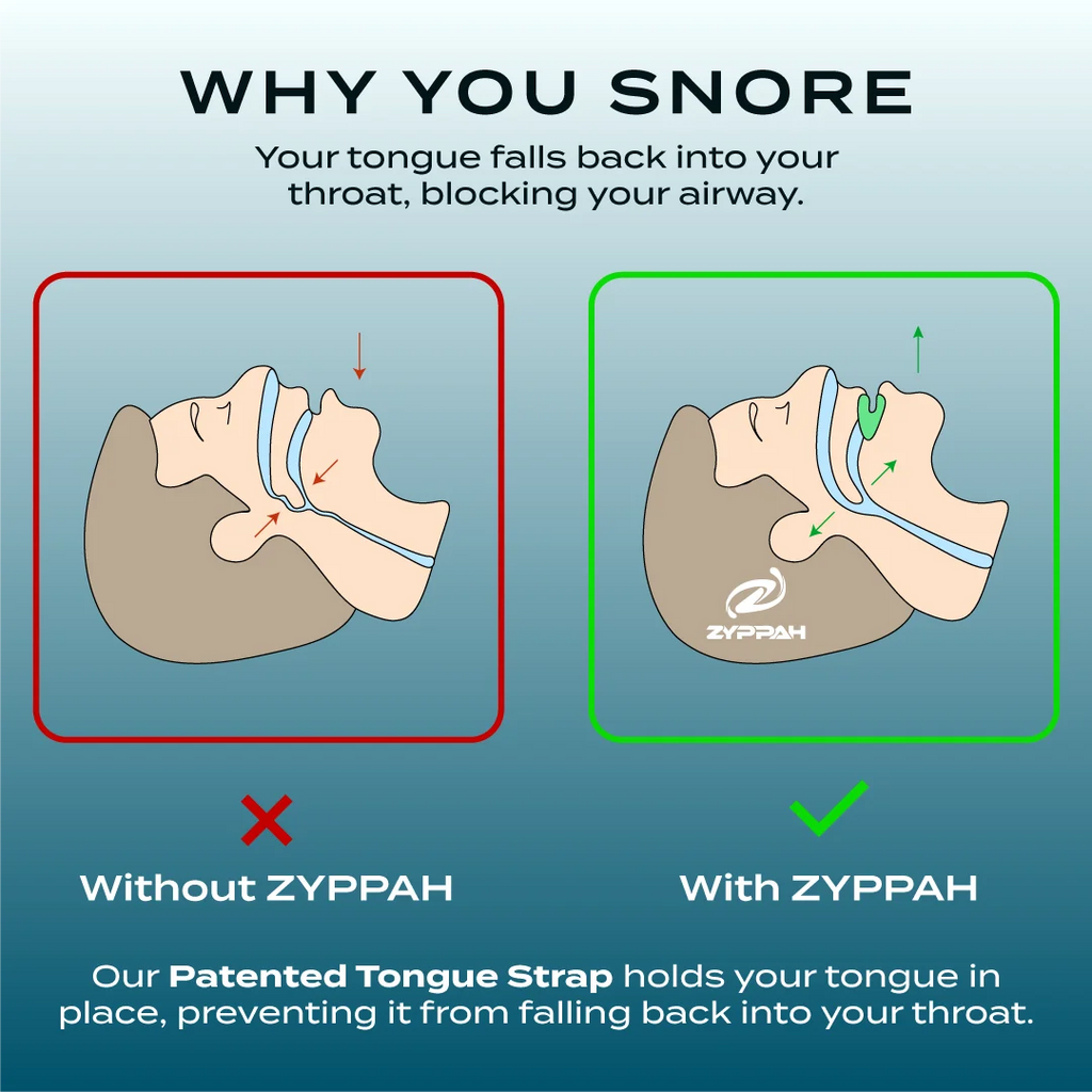 Anti Snoring Hybrid Oral Appliance Z5064