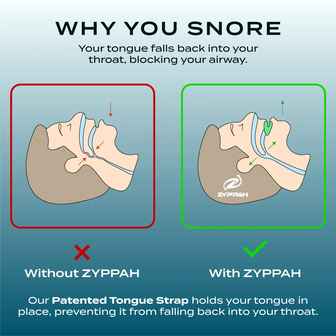 Anti Snoring Hybrid Oral Appliance Z5064